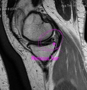 Meniscus Tear...ouch!